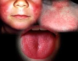 Uşaqlarda yeni infeksiya bulaşır: Pediatır simptomlardan danışdı
